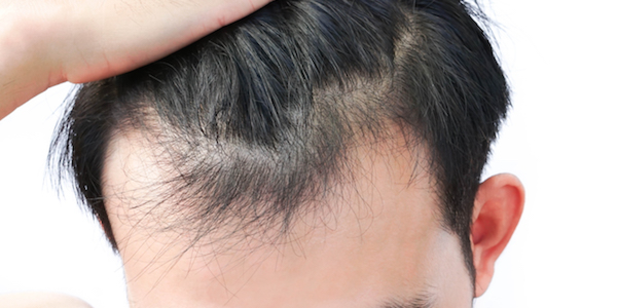 Hair loss Treatment Dr. Gayatri’s Cosmetic Clinic